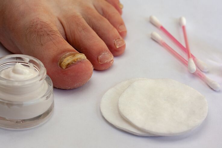 tratamento de fungo de dedo do pé com creme de fungo