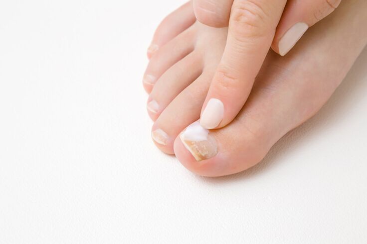 tratamento dos dedos dos pés com pomada para fungos