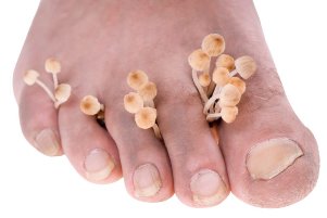 o fungo nos pés sintomas