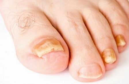 amarelecimento das unhas dos pés com fungo