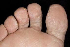 sintomas de fungos na pele dos pés