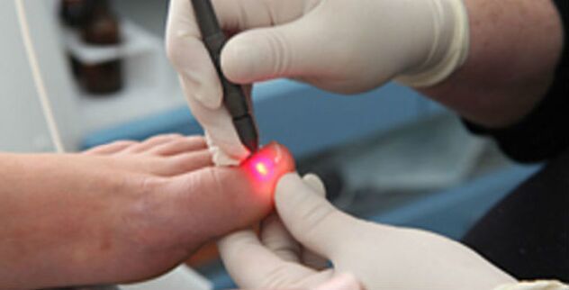 Terapia a laser para fungos nas unhas