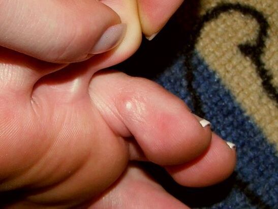 sintomas do fungo do dedo do pé