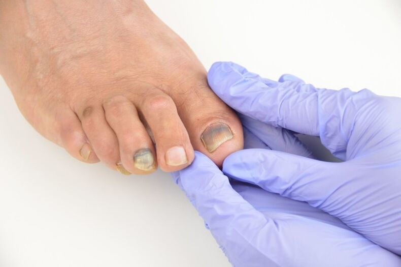 Exame médico das unhas dos pés afetadas por um fungo