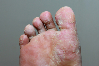 Grave a fase de micose a pele dos dedos dos pés