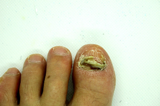 O fungo nas unhas dos dedos – duro fase